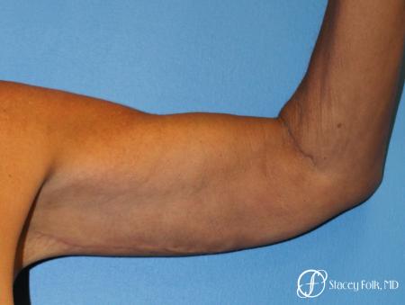 Denver Brachioplasty 8457 - After Image 1