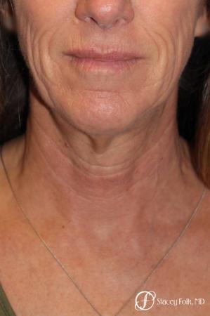Denver Facial Rejuvenation Face lift, Fat Injections, and Laser Resurfacing 7132 - Before and After Image 3