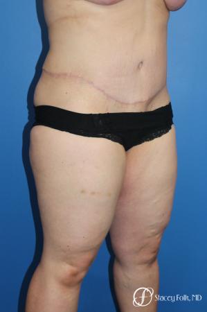 Tummy Tuck (Abdominoplasty) - After Image 2