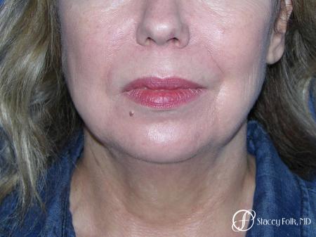 Denver Facial Rejuvenation Facelift, Fat Transfer, and Laser Resurfacing 8513 - Before and After Image 3