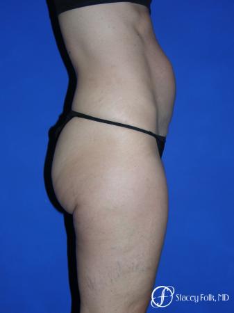 Denver Tummy Tuck Abdominoplasty 5485 - Before and After Image 2