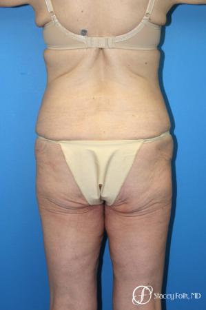 Denver Body Lift Belt lipectomy 5268 - Before Image 2