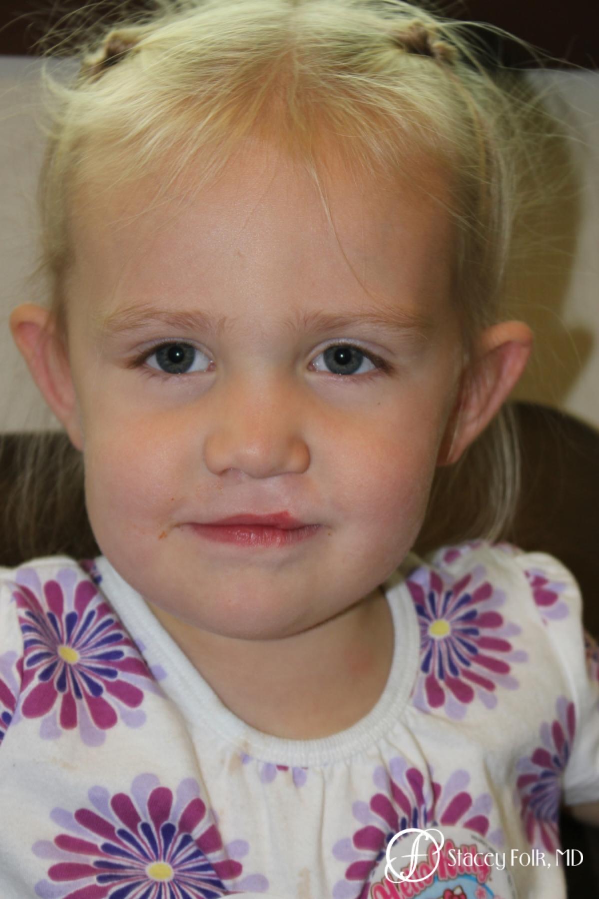 Denver Cleft Lip and Palate Repair 4776 - Before and After 2
