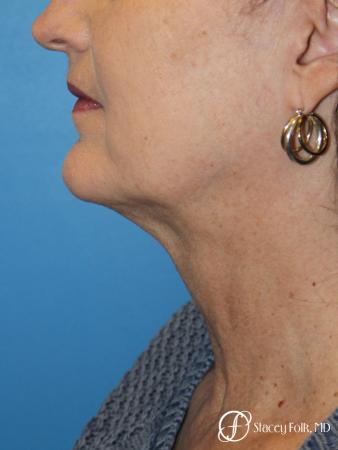 Denver Facial Rejuvenation Facelift, Blepharoplasty, Fat Transfer, Laser Resurfacing 10350 - Before Image 1