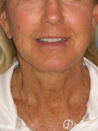 Denver Facial Rejuvenation Face Lift and Laser Resurfacing 7119 - After Image 3