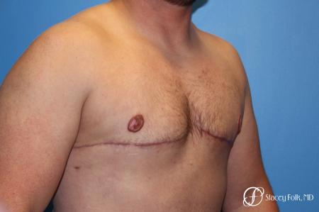 Denver FTM Female to male top surgery 5252 - After Image 2
