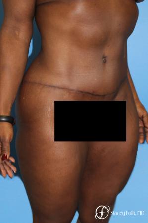 Denver Tummy Tuck - Abdominoplasty 7514 - After Image 3