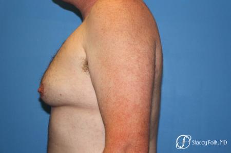 Denver FTM Female to Male Top Surgery 7109 - Before and After Image 3