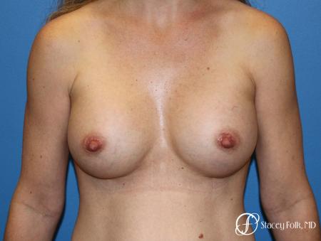 Denver Breast Augmentation using Textured Sientra Breast Implants 8414 - After Image 1