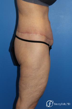 Denver Body Lift 10301 - After Image 4