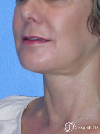 Denver Facial Rejuvenation Face Lift and Fat Injections 7117 - After Image 2