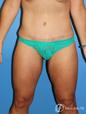 Denver Tummy Tuck Abdominoplasty 5368 - After Image 1