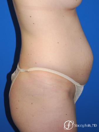 Denver Tummy Tuck - Abdominoplasty 10351 - Before and After Image 3