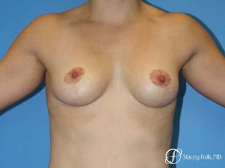 Denver Breast Lift - Mastopexy 7981 - After Image 1