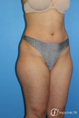 Denver Liposuction 8512 - Before and After Image 2