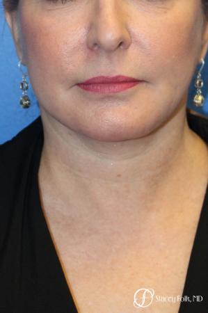 Denver Facial Rejuvenation 9894 - After Image 2