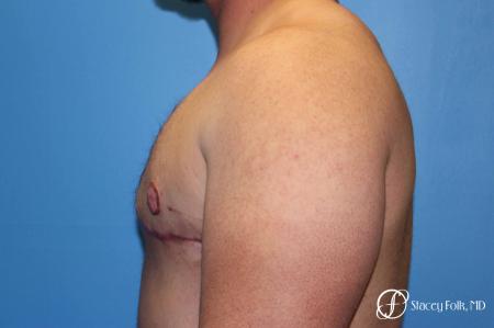 Denver FTM Female to male top surgery 5252 - After Image 5
