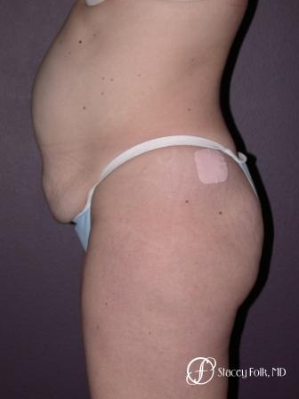 Denver Tummy Tuck 21 - Before and After Image 2