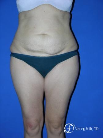 Denver Tummy Tuck 34 - Before Image 1