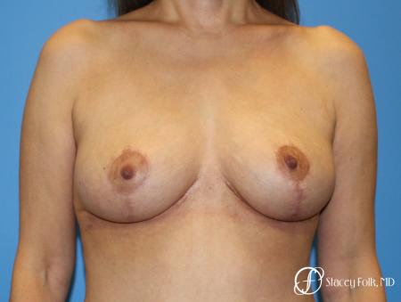 Denver Breast Lift - Mastopexy 7984 - After Image 1