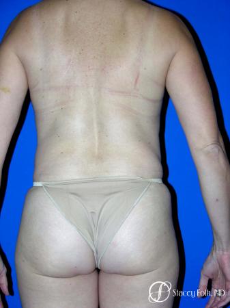 Denver Coolsculpting 8161 - After Image 1