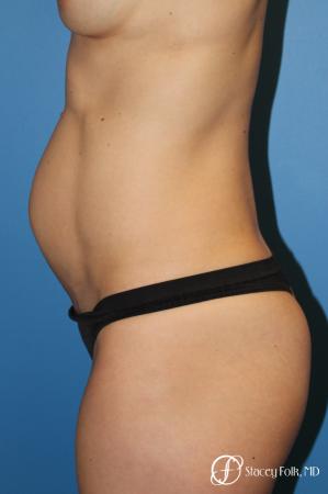 Denver Tummy Tuck (Abdominoplasty) 11239 - Before Image 3