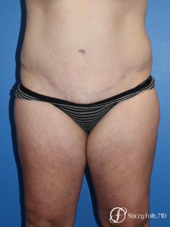 Denver Tummy Tuck (Abdominoplasty) and Liposuction 10381 - After Image 1