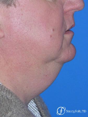 Denver Facial Rejuvenation Face lift, and Fat injections 7157 - Before and After Image 2