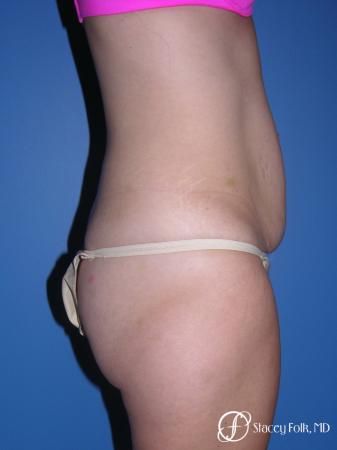 Denver Tummy Tuck (Abdominoplasty) 4782 - Before and After Image 2