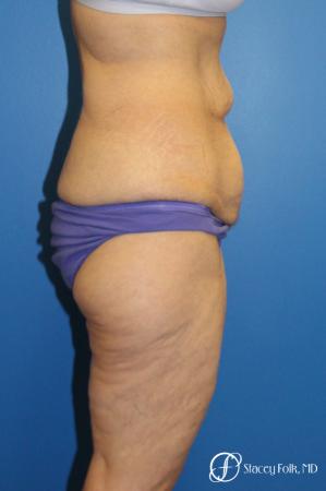 Denver Body Lift 10301 - Before and After Image 4