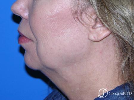 Denver Facial Rejuvenation Facelift, Fat Transfer, and Laser Resurfacing 8513 - Before Image 1