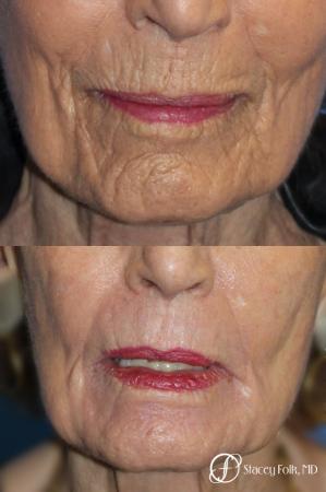 Laser Skin Resurfacing - Before Image 1