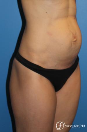 Denver Tummy Tuck (Abdominoplasty) 11239 - Before Image 4