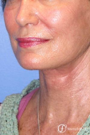 Denver Facial Rejuvenation Face Lift, Fat Injections, Laser Resurfacing 7116 - After Image 2