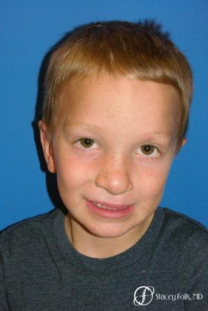 Denver Cleft Lip and Palate Repair 964 - Before and After Image 2