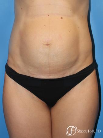 Denver Tummy Tuck (Abdominoplasty) 11239 - Before Image 1