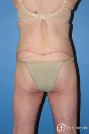 Denver Body Lift Belt lipectomy 5268 - After Image 2