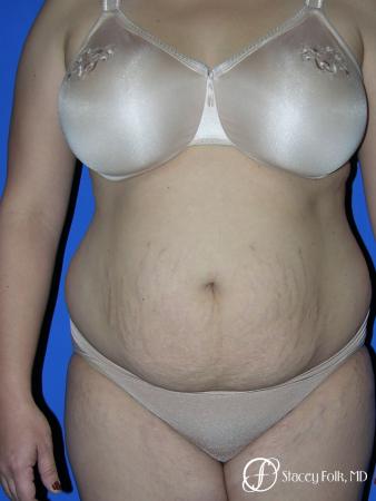 Denver Mommy makeover, breast reduction, abdominoplasty and liposuction 5353 - Before Image 1