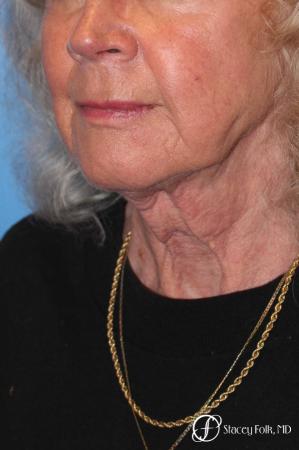 Denver Facial Rejuvenation Face lift, Fat Injections, and Laser Resurfacing 7131 - Before Image 2