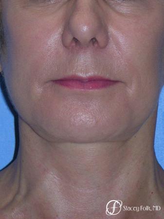 Denver Facial Rejuvenation Face Lift and Fat Injections 7117 - After Image 3