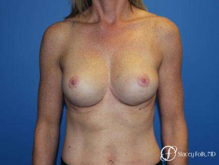 Breast Augmentation with Breast Lift (Augmentation/Mastopexy) - After Image 1
