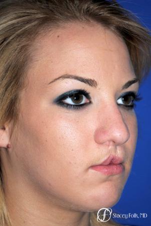 Denver Septorhinoplasty and Cleft Lip Repair 8162 - Before and After Image 3