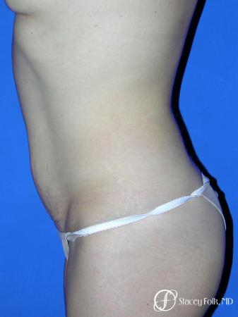 Denver Coolsculpting 8160 - Before and After Image 2