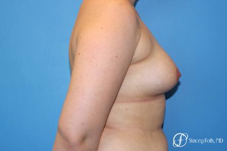 Denver FTM Top Surgery 5088 - Before and After Image 3