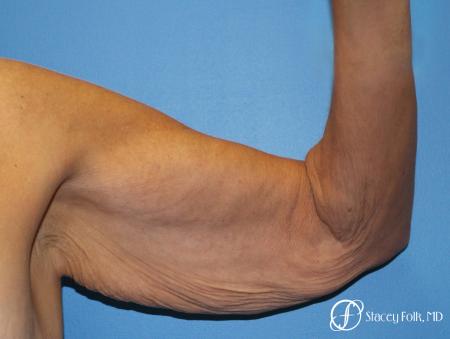 Denver Brachioplasty 8457 - Before Image 1
