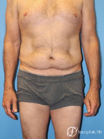 Denver Body Lift - Belt Lipectomy 8570 - Before Image 1
