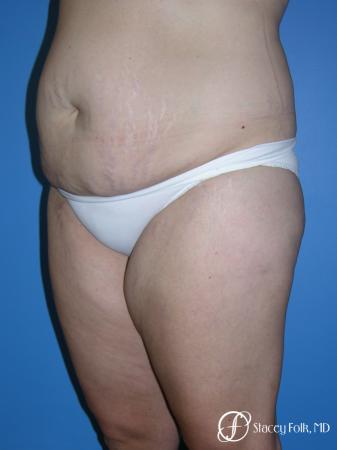 Denver Tummy Tuck (Abdominoplasty) and Liposuction 10381 - Before Image 2