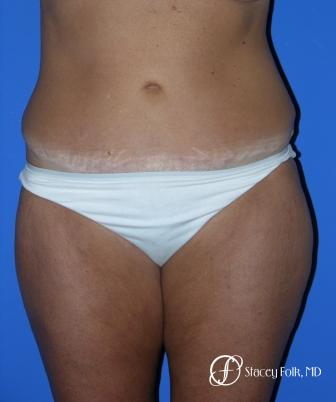 Denver Tummy Tuck 18 - After