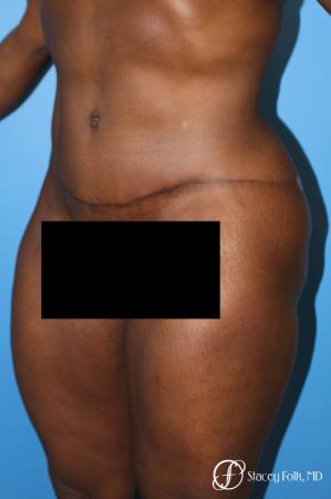 Denver Tummy Tuck - Abdominoplasty 7514 - After Image 2