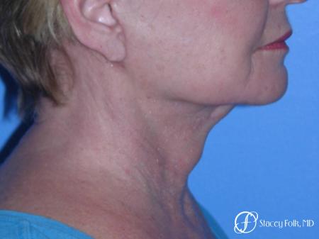 Denver Facial Rejuvenation Face Lift, Fat Injections, and Laser Resurfacing 7120 - After Image 1